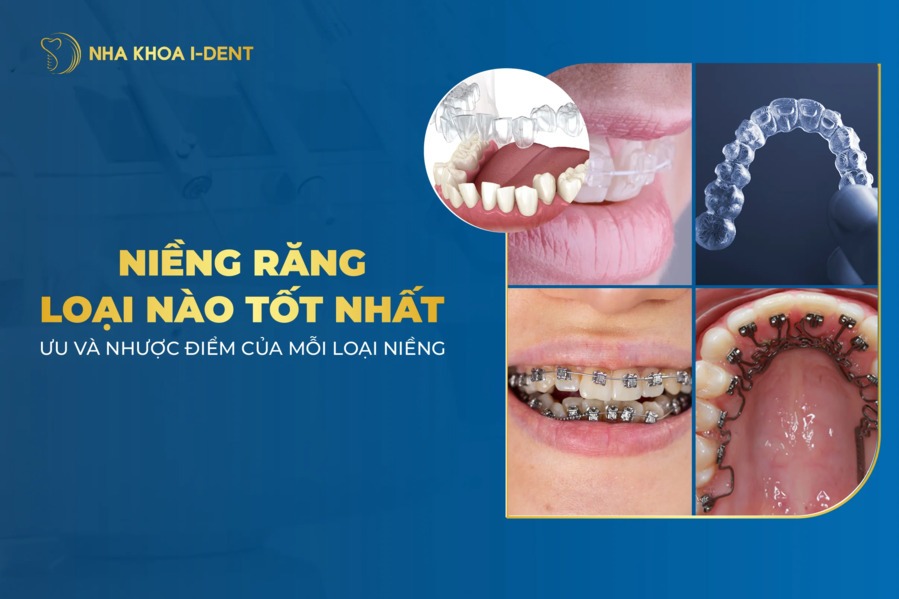 Nên chọn niềng răng loại nào tốt nhất hiện nay?