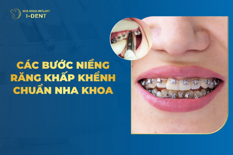 Các bước trong quy trình niềng răng khấp khểnh chuẩn y khoa