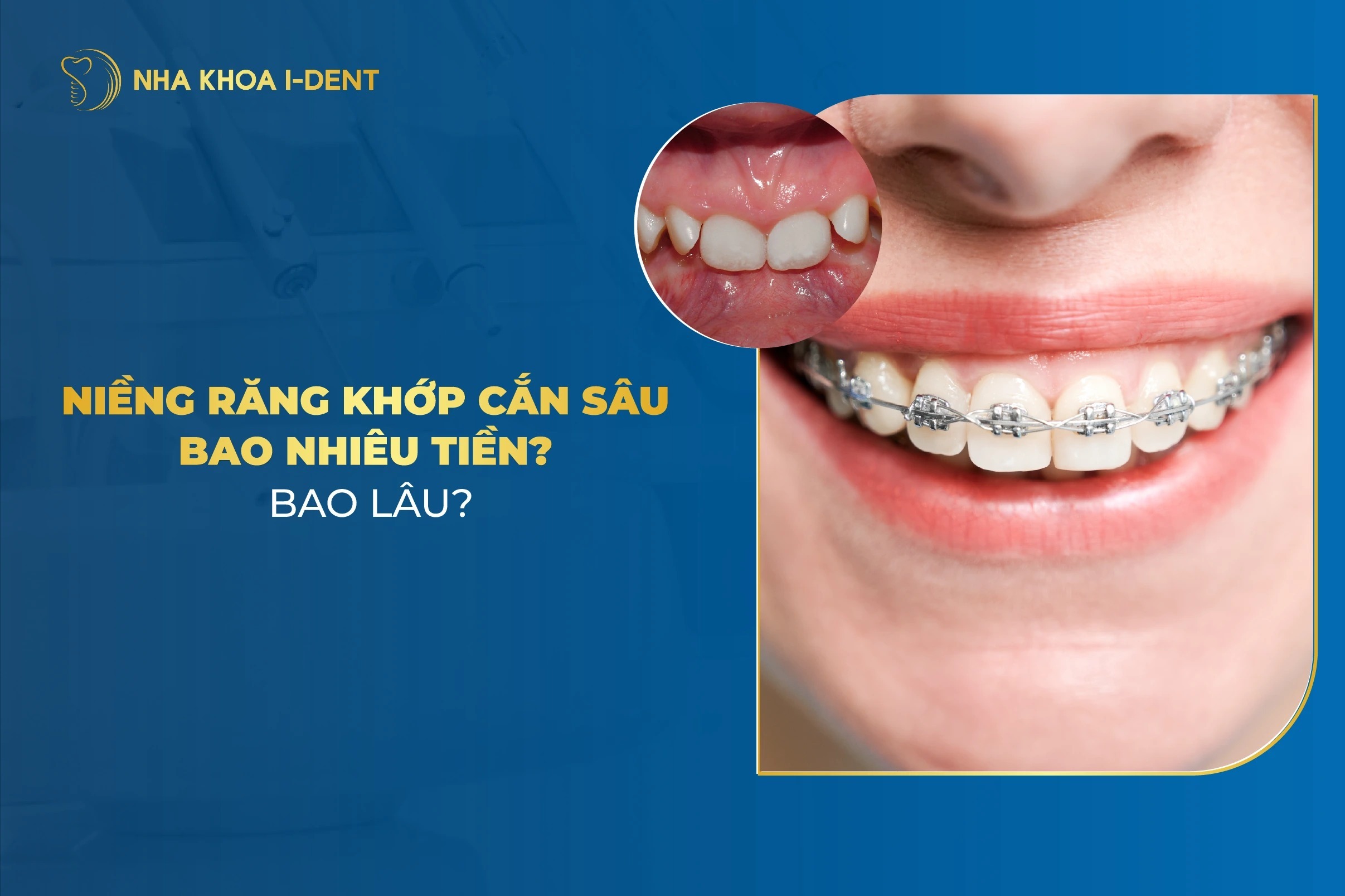Niềng răng khớp cắn sâu: Thời gian, giá và quy trình