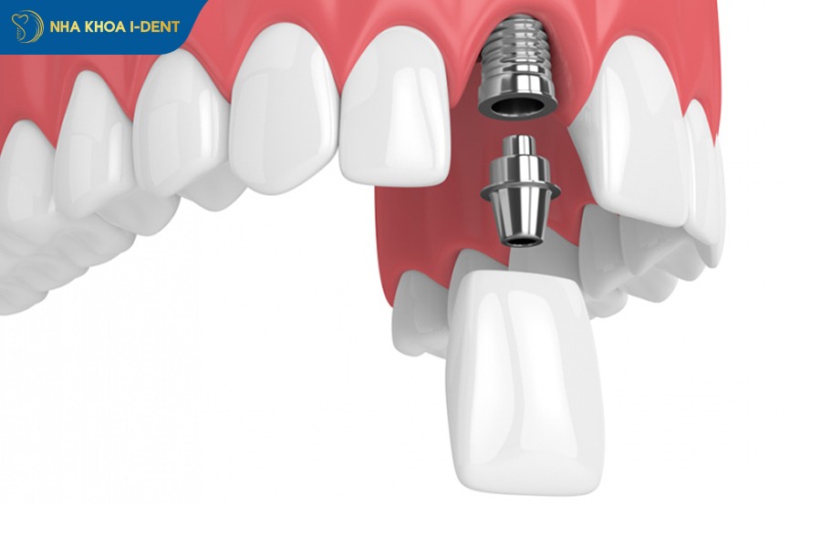 Trồng răng implant là phương pháp hiệu quả để phục hồi răng cửa bị gãy