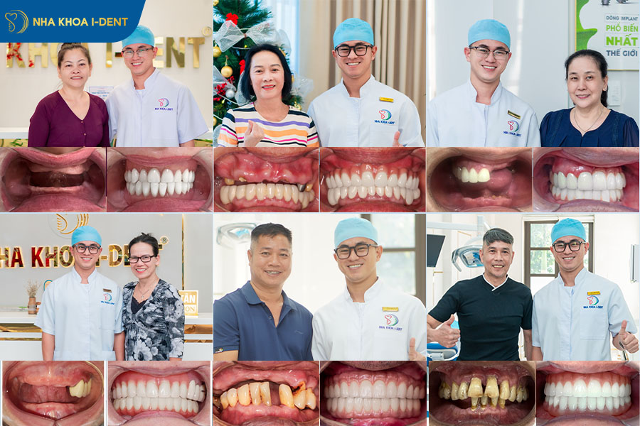 trụ implant mis c1