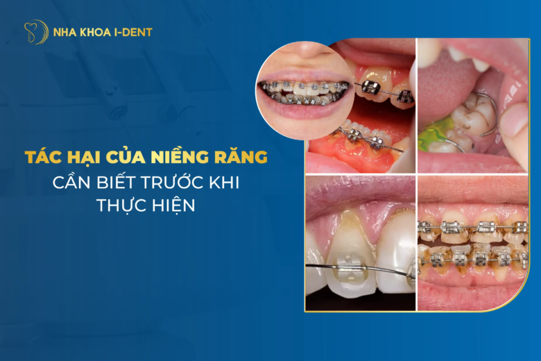 6 tác hại của niềng răng cần lưu ý