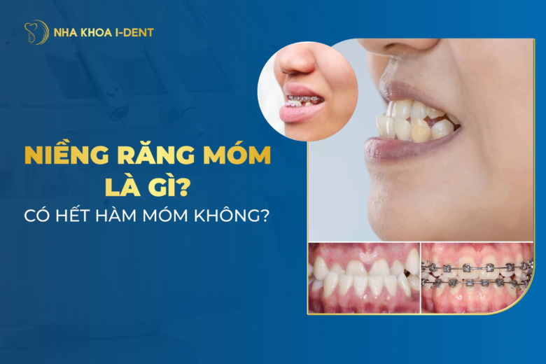 Niềng Răng Móm Là Gì? Bị Móm Có Nên Niềng?