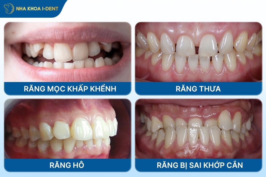 clear aligner