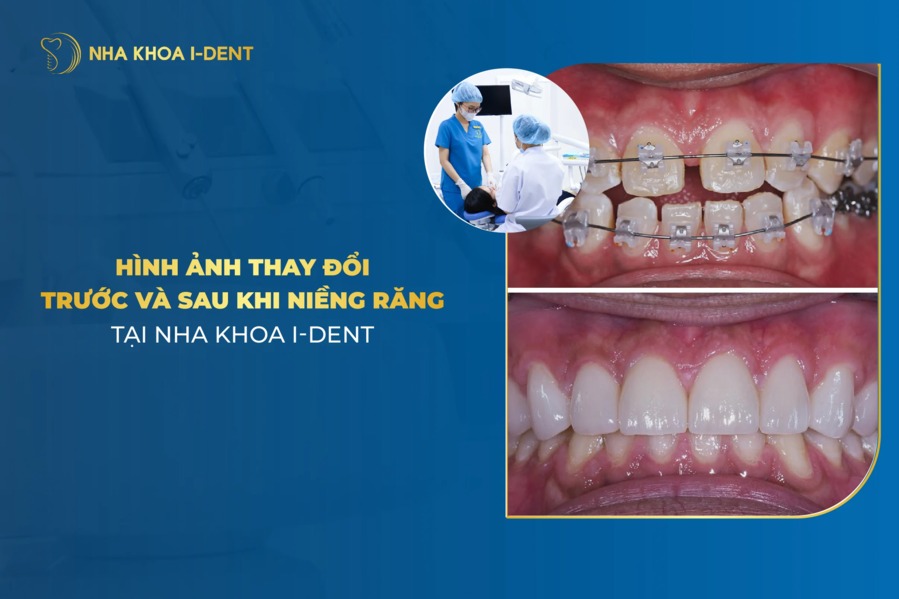 Hình ảnh niềng răng thay đổi trước và sau khi niềng tại I-Dent