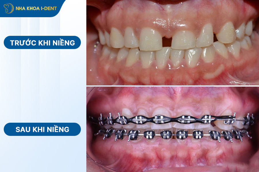 hình niềng răng