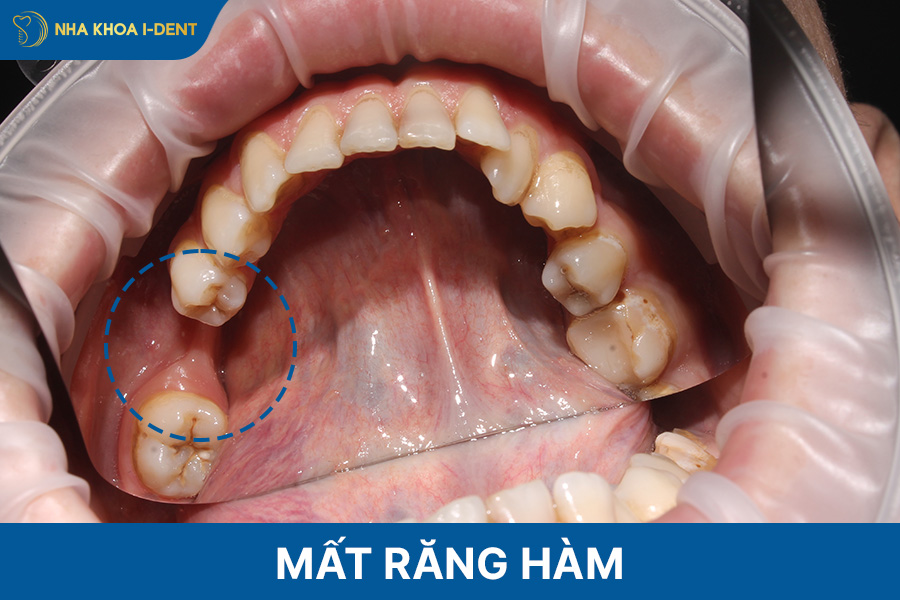 mất răng hàm