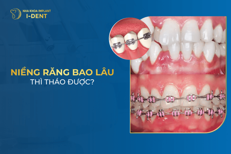Thời Gian Niềng Răng Mất Khoảng Bao Lâu Tháo Niềng?