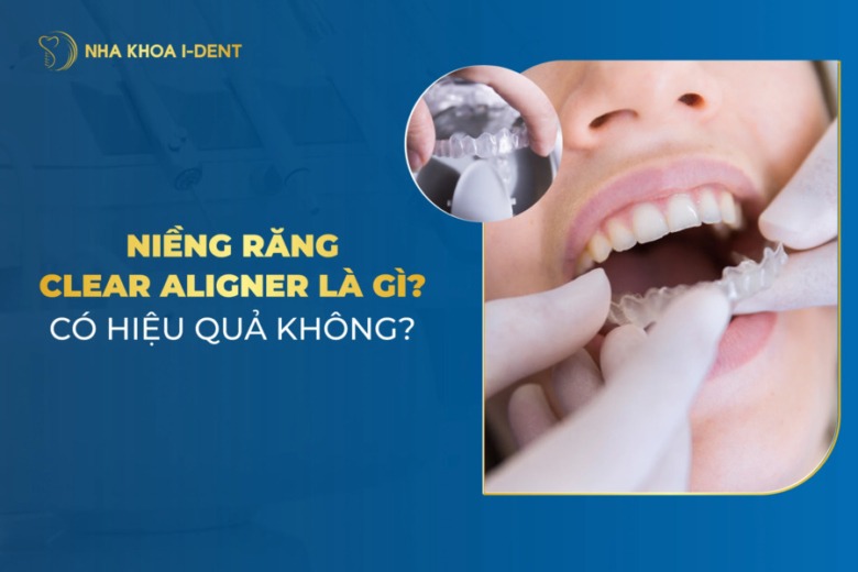 Niềng răng Clear Aligner: Hiệu quả và giá niềng