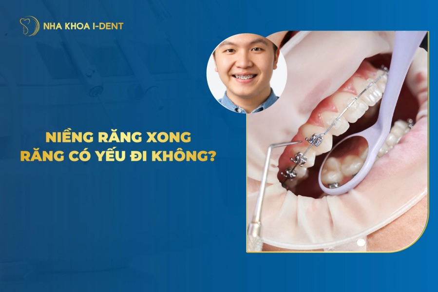 [Giải Đáp] Niềng Răng Có Làm Răng Bị Yếu Không