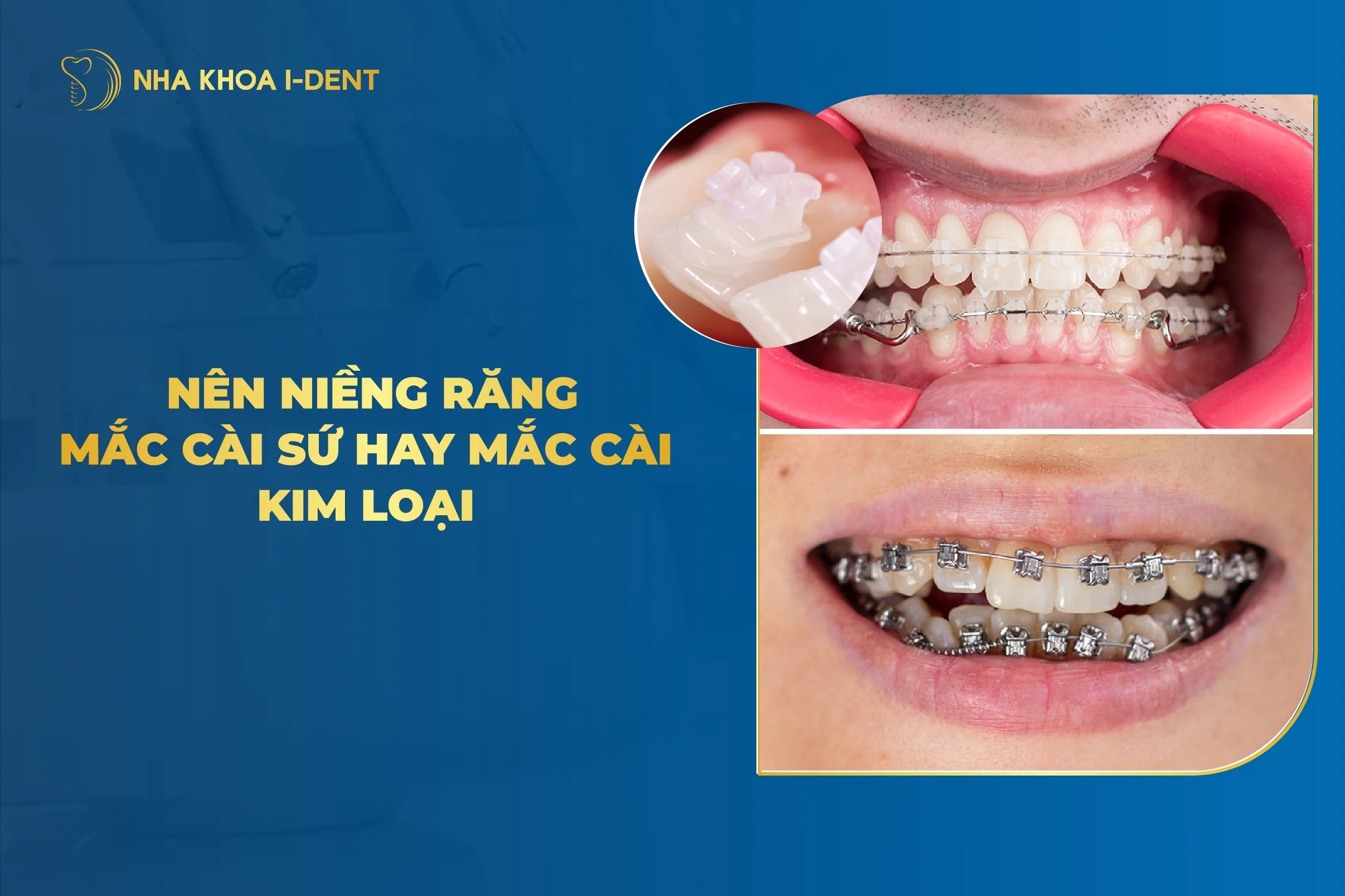 Nên niềng răng mắc cài sứ hay kim loại? Chọn loại nào?