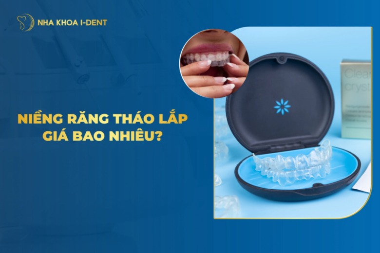 Giá niềng răng tháo lắp bao nhiêu tiền? Bảng giá 2026