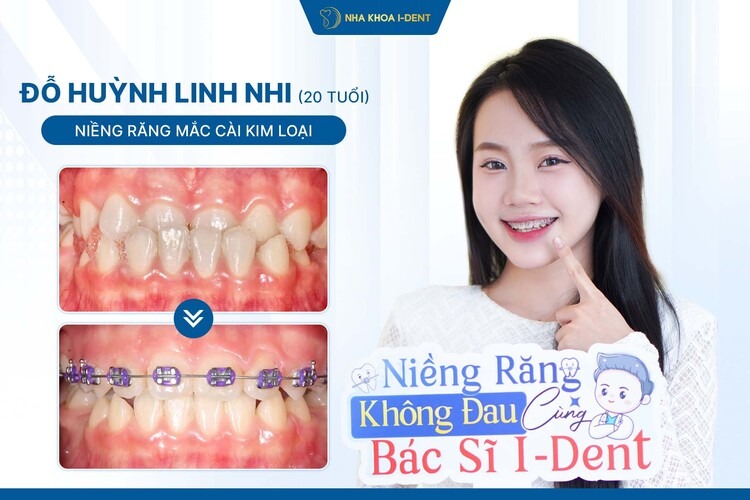 HÀNH TRÌNH NIỀNG RĂNG BẠN LINH NHI: CẢI THIỆN KHỚP CẮN NGƯỢC SAU 8 THÁNG