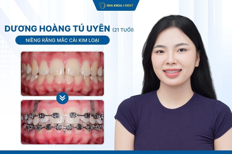 HÀNH TRÌNH NIỀNG RĂNG BẠN TÚ UYÊN: TỪ “RĂNG CÁNH BƯỚM” ĐẾN NỤ CƯỜI 10 ĐIỂM