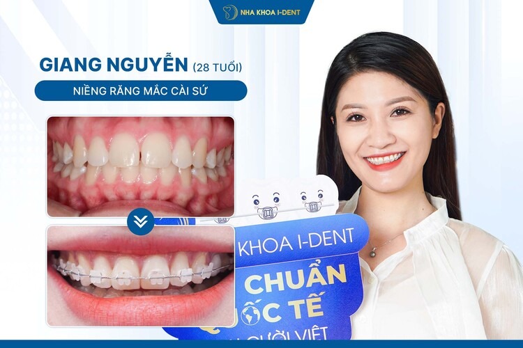HÀNH TRÌNH NIỀNG RĂNG CHỊ GIANG NGUYỄN: LỰA CHỌN CẦN THIẾT CHO NỤ CƯỜI CHUẨN MC