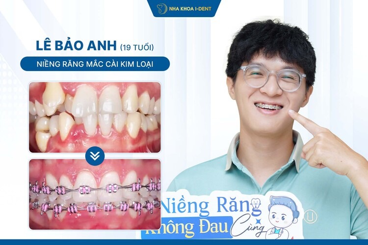 HÀNH TRÌNH NIỀNG RĂNG BẠN LÊ BẢO ANH: TỪ NỖI SỢ CƯỜI ĐẾN NỤ CƯỜI TỰ TIN