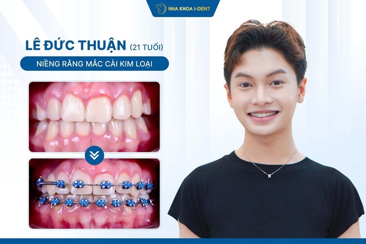 HÀNH TRÌNH NIỀNG RĂNG CỦA ĐỨC THUẬN: KHÔI PHỤC SỰ TỰ TIN