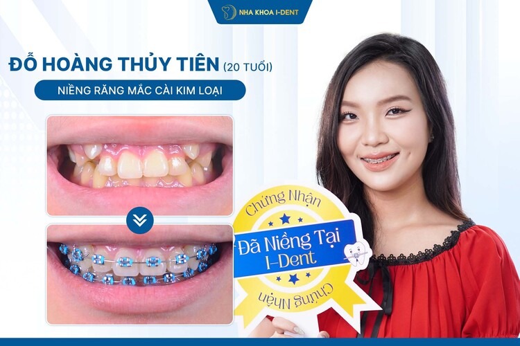 HÀNH TRÌNH NIỀNG RĂNG CHỊ THỦY TIÊN: TỪ RĂNG LỆCH LẠC ĐẾN NỤ CƯỜI CÂN ĐỐI
