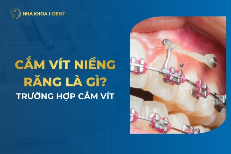 Cắm vít niềng răng là gì? Cắm vis có đau không?