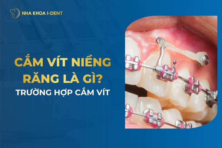 Cắm vít niềng răng là gì? Cắm vis có đau không?