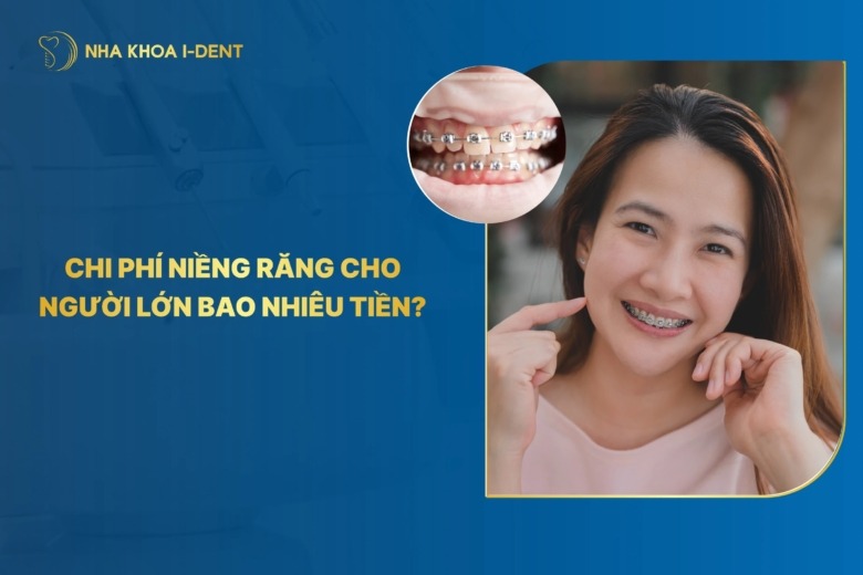 Chi phí niềng răng cho người lớn năm 2026 bao nhiêu?