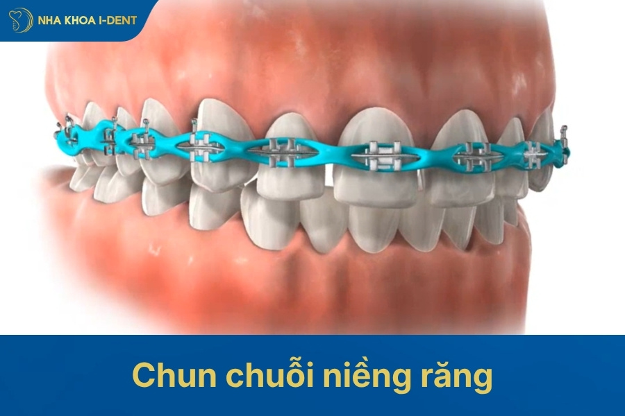 chun chuỗi chỉnh nha