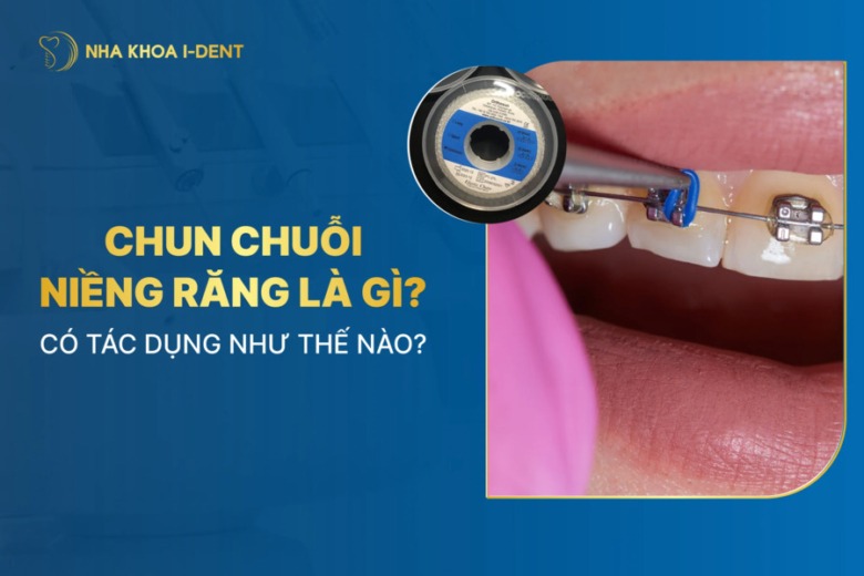 Chun chuỗi niềng răng là gì? Có công dụng như thế nào?
