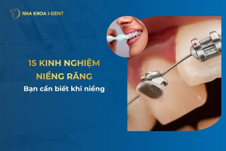 Top 15 kinh nghiệm niềng răng bạn cần biết khi niềng