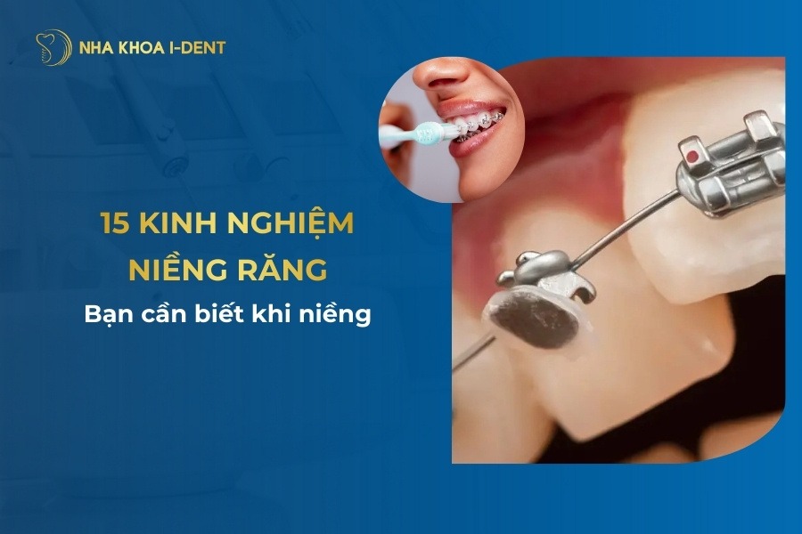 Top 15 kinh nghiệm niềng răng bạn cần biết khi niềng