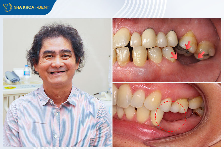 mất răng phải làm sao