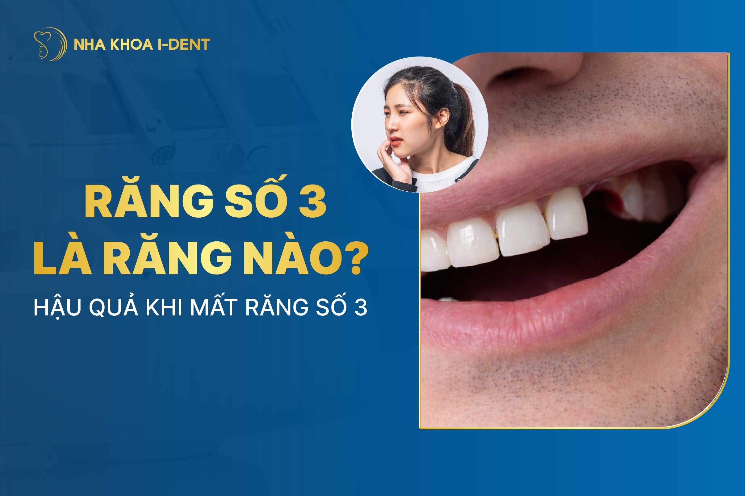 Răng nào là răng số 3? Hậu quả khi mất răng số 3