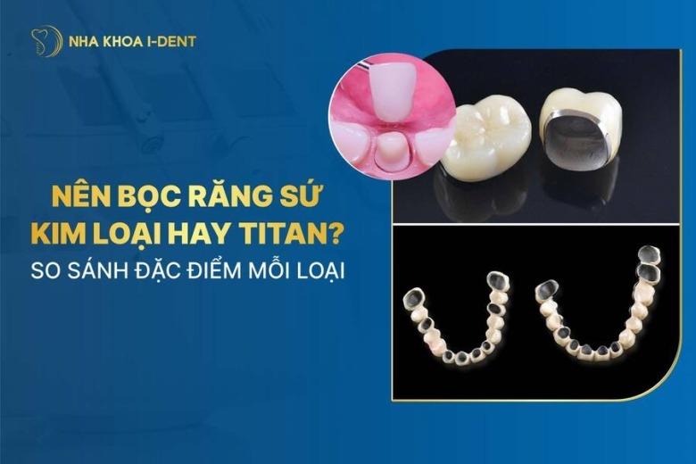 Nên bọc răng sứ kim loại hay Titan? So sánh đặc điểm mỗi loại