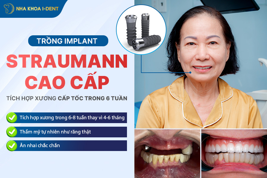 nên trồng răng loại nào
