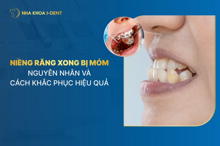 Nguyên nhân niềng răng xong bị móm và cách khắc phục