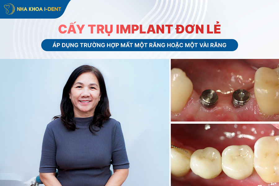 trồng răng bị mất chân răng.