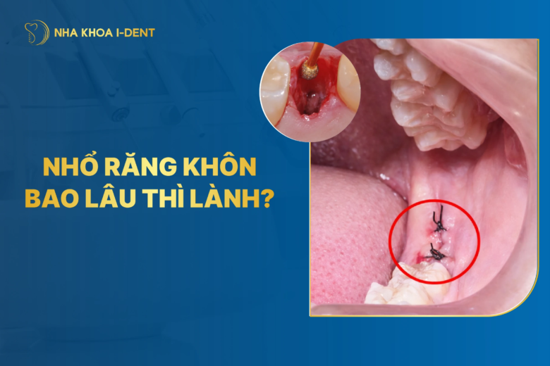 Nhổ răng khôn bao lâu thì lành? Cách chăm sóc nhanh lành