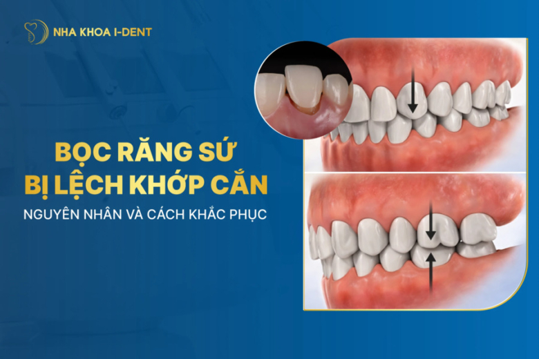 Bọc răng sứ bị lệch khớp cắn: Nguyên nhân và cách điều trị