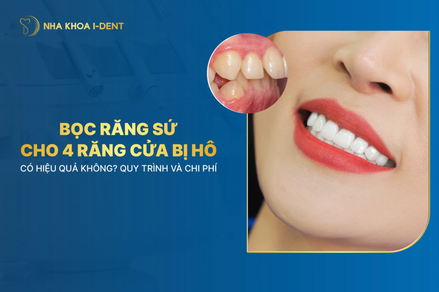 Bọc răng sứ cho 4 răng cửa bị hô: Lợi ích, chi phí và quy trình