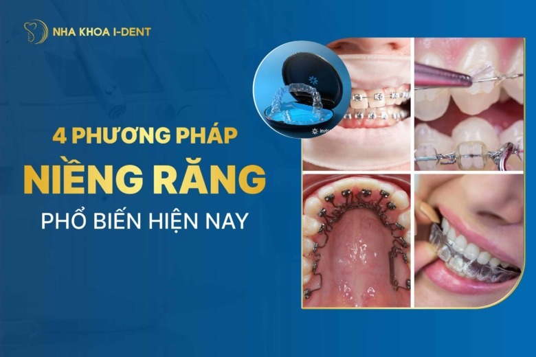 4 phương pháp Niềng răng phổ biến hiện nay