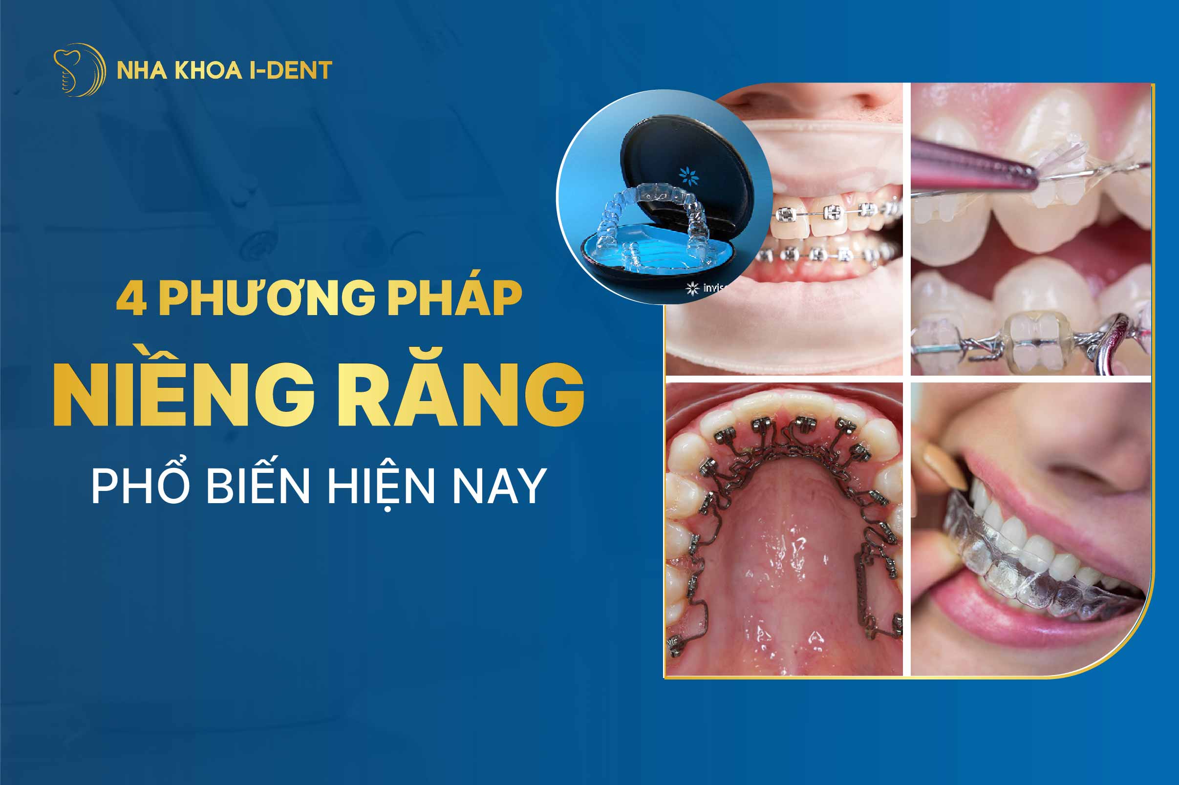 4 phương pháp Niềng răng phổ biến hiện nay