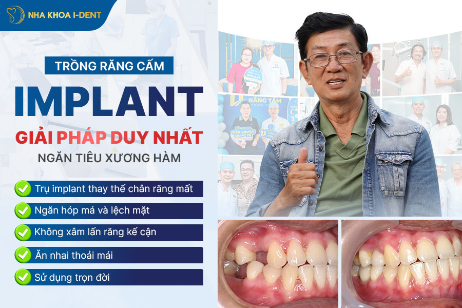 giá trồng răng cấm
