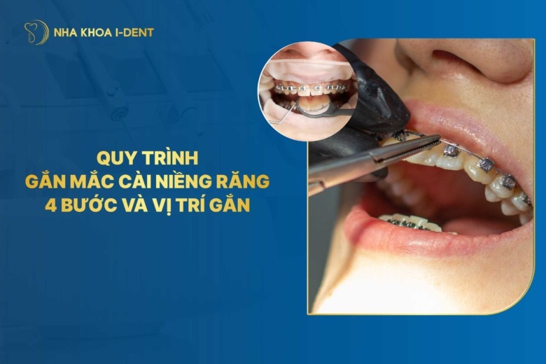 Gắn mắc cài niềng răng là gì? Quy trình gắn mắc cài