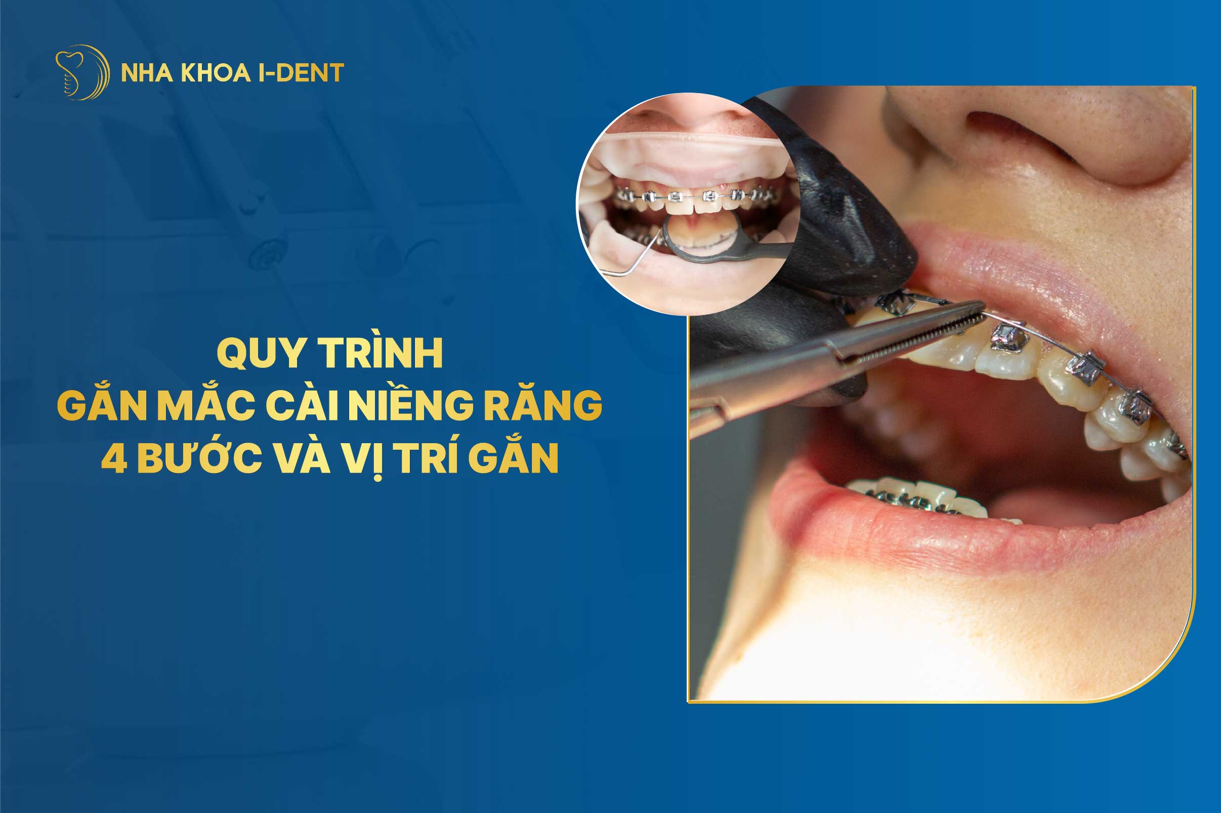 Gắn mắc cài niềng răng là gì? Quy trình gắn mắc cài