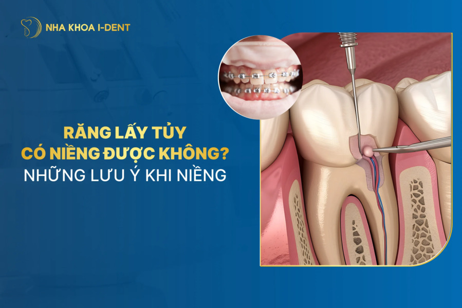 Răng lấy tủy có niềng được không? Chuyên gia giải đáp