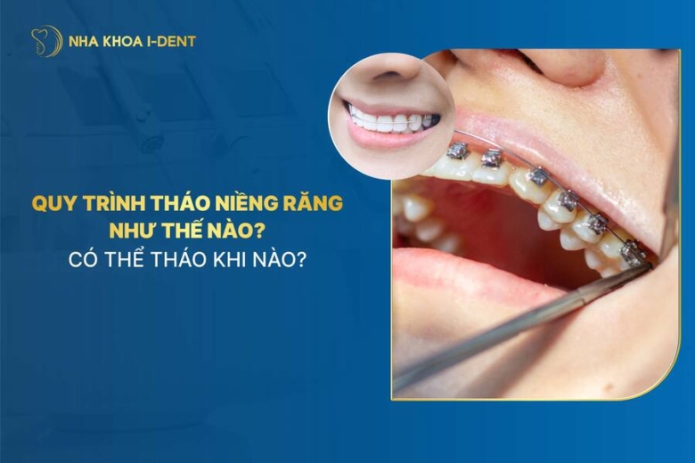 Quy trình tháo niềng răng như thế nào? Dấu hiệu sắp tháo niềng