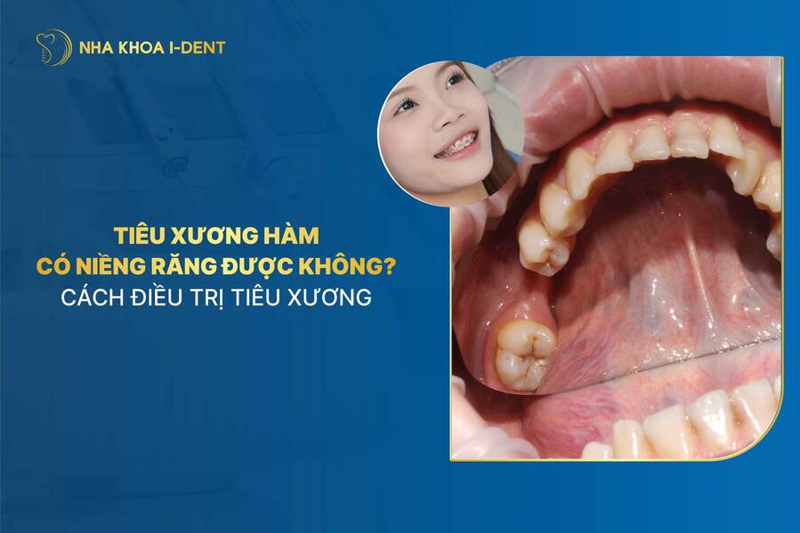 Tiêu xương hàm có niềng răng được không? Bác sĩ giải đáp