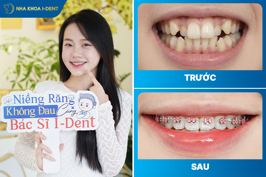 hàm răng đều