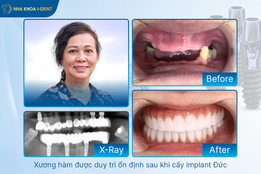 implant đức