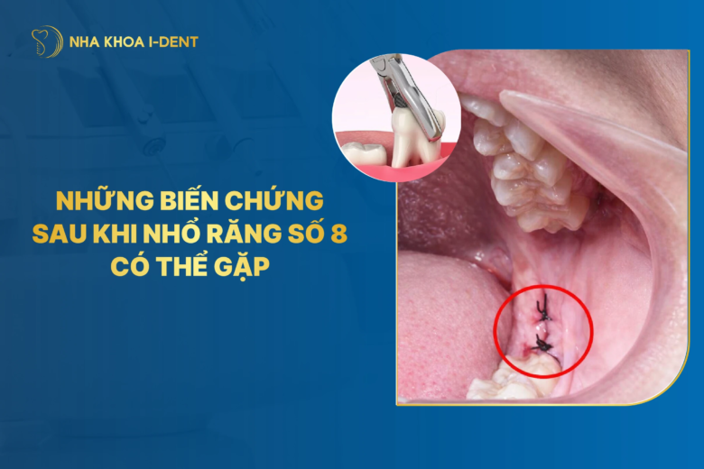 10 biến chứng sau khi nhổ răng khôn (răng số 8) có thể gặp
