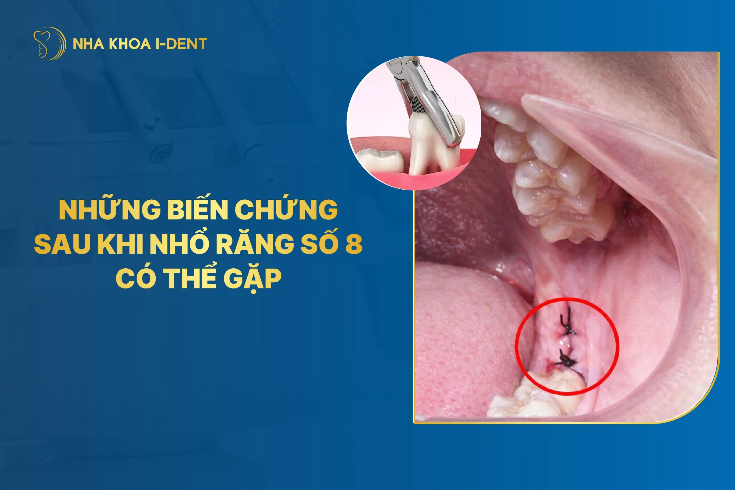 10 biến chứng sau khi nhổ răng khôn (răng số 8) có thể gặp